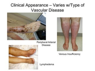 Clinical Appearance – Varies w/Type of
Vascular Disease
Venous Insufficiency
Lymphedema
Peripheral Arterial
Disease
 