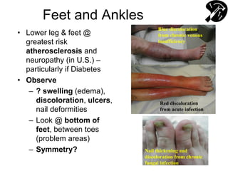 Feet and Ankles
• Lower leg & feet @
greatest risk
atherosclerosis and
neuropathy (in U.S.) –
particularly if Diabetes
• Observe
– ? swelling (edema),
discoloration, ulcers,
nail deformities
– Look @ bottom of
feet, between toes
(problem areas)
– Symmetry?
Blue discoloration
from chronic venous
insufficiency
Red discoloration
from acute infection
Nail thickening and
discoloration from chronic
fungal infection
 