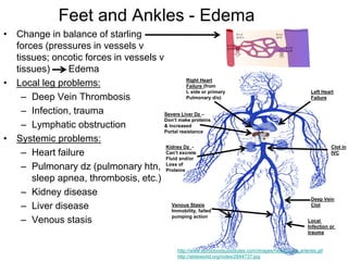 Feet and Ankles - Edema
• Change in balance of starling
forces (pressures in vessels v
tissues; oncotic forces in vessels v
tissues) Edema
• Local leg problems:
– Deep Vein Thrombosis
– Infection, trauma
– Lymphatic obstruction
• Systemic problems:
– Heart failure
– Pulmonary dz (pulmonary htn,
sleep apnea, thrombosis, etc.)
– Kidney disease
– Liver disease
– Venous stasis
http://www.eurobloodsubstitutes.com/images/heartCircul_arteries.gif
http://slideworld.org/notes/2844737.jpg
Left Heart
Failure
Right Heart
Failure (from
L side or primary
Pulmonary d/o)
Severe Liver Dz –
Don’t make proteins
& increased
Portal resistance
Clot in
IVC
Deep Vein
Clot
Kidney Dz -
Can’t excrete
Fluid and/or
Loss of
Proteins
Venous Stasis
Immobility, failed
pumping action
Local
Infection or
trauma
 