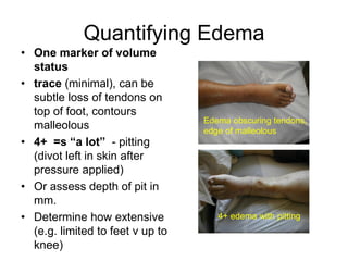 Quantifying Edema
• One marker of volume
status
• trace (minimal), can be
subtle loss of tendons on
top of foot, contours
malleolous
• 4+ =s “a lot” - pitting
(divot left in skin after
pressure applied)
• Or assess depth of pit in
mm.
• Determine how extensive
(e.g. limited to feet v up to
knee)
Edema obscuring tendons,
edge of malleolous
4+ edema with pitting
 
