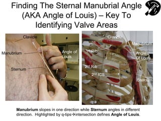 Finding The Sternal Manubrial Angle
(AKA Angle of Louis) – Key To
Identifying Valve Areas
Manubrium
Sternum
Angle of
Louis
Clavicle Clavicle
1st Rib
2nd Rib
Sternum
Manubrium
Angle
Of Louis
2nd ICS
Manubrium slopes in one direction while Sternum angles in different
direction. Highlighted by q-tipsintersection defines Angle of Louis.
 