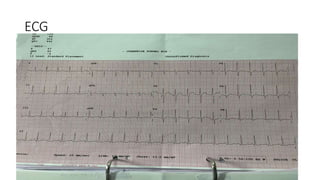 ECG
 