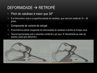 DEFORMIDADE  RETROPÉ
• Pitch do calcâneo é maior que 30º
 É a linha entre o solo e a superfície plantar do calcâneo, que varia em media de 10 – 30
graus.
• Componente de varismo do retropé:
 Proeminência plantar exagerada da tuberosidade do calcâneo e atrofia do tríceps sural.
 Ocorre hiperceratose sob o calcanhar conferido o pé cavo  Semelhante ao cabo de
pistola ( pistol grip deformity ).
 
