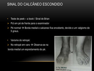 SINAL DO CALCÂNEO ESCONDIDO
• Teste de peek – a book / Sinal de Brian
 Pct em pé de frente para o examinador
 Pé normal  Borda medial o calcaneo fica encoberto, devido o um valgismo de
5 graus.
• Varismo do retropé:
 No retropé em varo  Observa-se na
borda medial um espreitamento do pé.
 