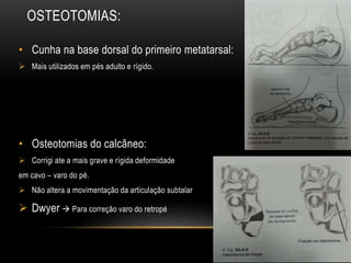 OSTEOTOMIAS:
• Cunha na base dorsal do primeiro metatarsal:
 Mais utilizados em pés adulto e rígido.
• Osteotomias do calcâneo:
 Corrigi ate a mais grave e rígida deformidade
em cavo – varo do pé.
 Não altera a movimentação da articulação subtalar
 Dwyer  Para correção varo do retropé
 