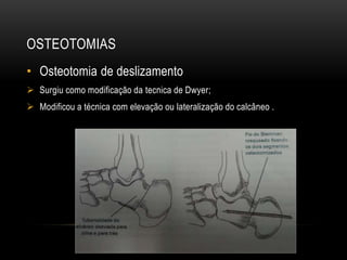 OSTEOTOMIAS
• Osteotomia de deslizamento
 Surgiu como modificação da tecnica de Dwyer;
 Modificou a técnica com elevação ou lateralização do calcâneo .
 