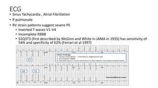ECG
• Sinus Tachycardia , Atrial Fibrillation
• P pulmonale
• RV strain patterns suggest severe PE
• Inverted T waves V1-V4
• Incomplete RBBB
• S1Q3T3 (first described by McGinn and White in JAMA in 1935) has sensitivity of
54% and specificity of 62% (Ferrari et al 1997)
 