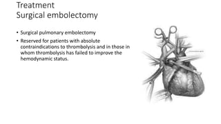 Treatment
Surgical embolectomy
• Surgical pulmonary embolectomy
• Reserved for patients with absolute
contraindications to thrombolysis and in those in
whom thrombolysis has failed to improve the
hemodynamic status.
 