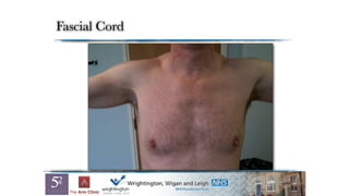 Fascial Cord
 