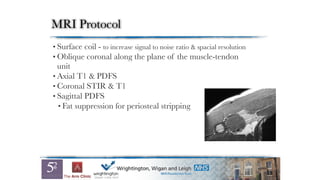 MRI Protocol
• Surface coil - to increase signal to noise ratio & spacial resolution
• Oblique coronal along the plane of the muscle-tendon
unit
• Axial T1 & PDFS
• Coronal STIR & T1
• Sagittal PDFS
• Fat suppression for periosteal stripping
 