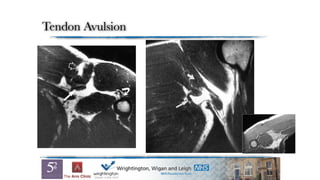 Tendon Avulsion
 