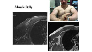Muscle Belly
 