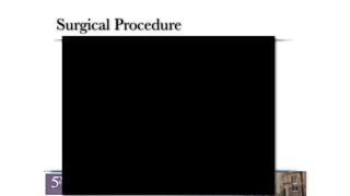 Surgical Procedure
Shah & Funk, TSES, 2010
 