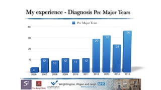 My experience - Diagnosis Pec Major Tears
Pec Major Tears
 