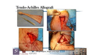 Tendo-Achilles Allograft
 