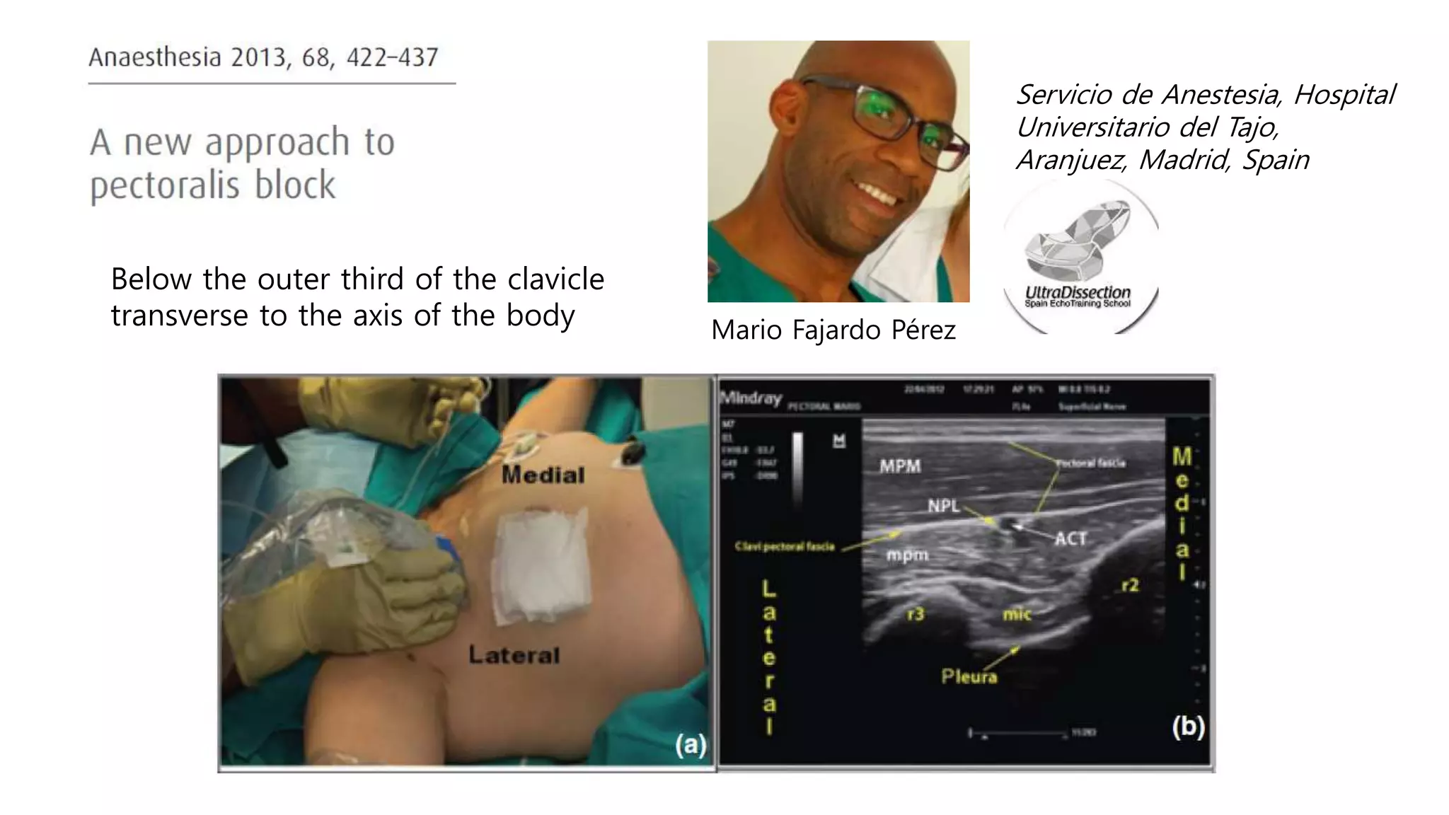 Pecs block, serratus plane block with literature review when and how | PPT
