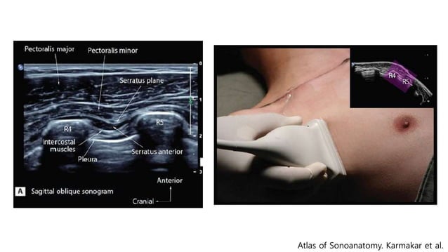 Pecs block, serratus plane block with literature review when and how | PPT