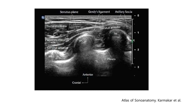 Pecs block, serratus plane block with literature review when and how | PPT