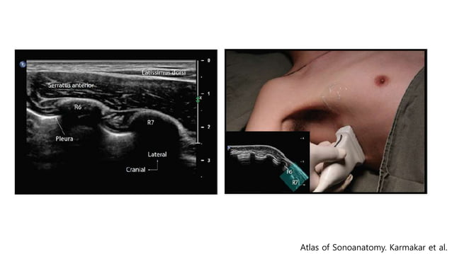 Pecs block, serratus plane block with literature review when and how | PPT