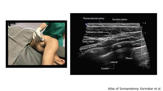 Pecs block, serratus plane block with literature review when and how | PPT