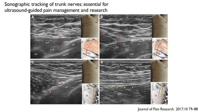 Pecs block, serratus plane block with literature review when and how | PPT