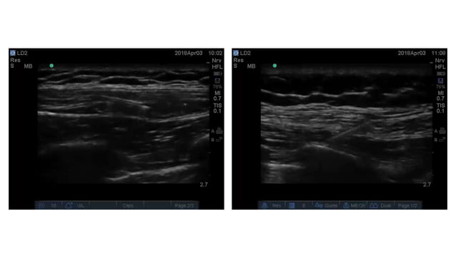 Pecs block, serratus plane block with literature review when and how | PPT