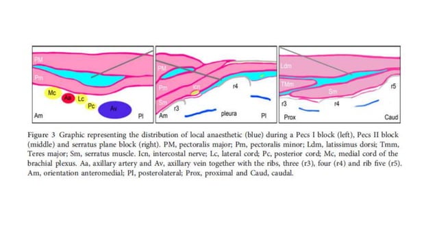 Pecs block, serratus plane block with literature review when and how | PPTX