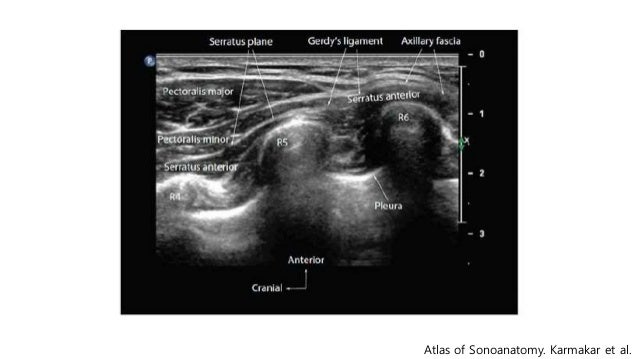 Pecs block, serratus plane block with literature review when and how