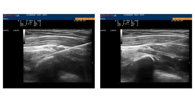 Pecs block, serratus plane block with literature review when and how