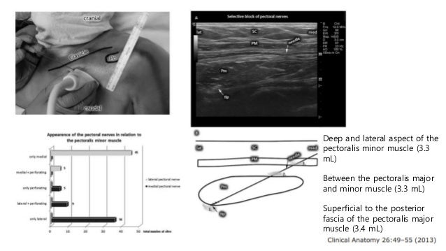 Pecs block, serratus plane block with literature review when and how