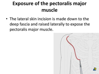Exposure of the pectoralis major
muscle
• The lateral skin incision is made down to the
deep fascia and raised laterally to expose the
pectoralis major muscle.
 