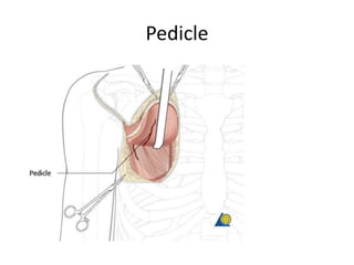 Pedicle
 