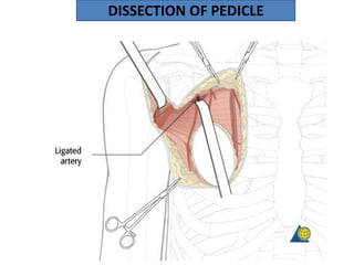 DISSECTION OF PEDICLE
 