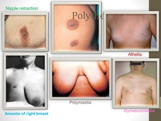 Amastia of right breast
Polymastia
Polythelia
Nipple retraction
Athelia
Gynaecomastia
 