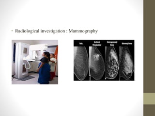 • Radiological investigation : Mammography
 