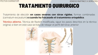 TRATAMIENTO QUIRURGICO
Tratamiento de elección en casos severos con tórax rígidos, formas combinadas
(carinatum-excavatum) o cuando ha fracasado el tratamiento ortopédico.
Técnica abierta. Técnica de Ravitch modificada, sigue los pasos descritos en la técnica
original, si bien en este caso se trata de rebajar el perfil del tórax anterior
PECTUS CARINATUM GÉNESIS MARTÍNEZ | X SEMESTREt
 