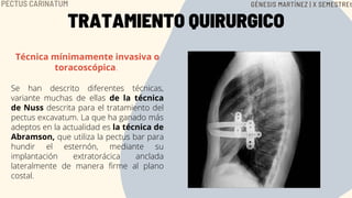 TRATAMIENTO QUIRURGICO
Técnica mínimamente invasiva o
toracoscópica.


Se han descrito diferentes técnicas,
variante muchas de ellas de la técnica
de Nuss descrita para el tratamiento del
pectus excavatum. La que ha ganado más
adeptos en la actualidad es la técnica de
Abramson, que utiliza la pectus bar para
hundir el esternón, mediante su
implantación extratorácica anclada
lateralmente de manera firme al plano
costal.
PECTUS CARINATUM GÉNESIS MARTÍNEZ | X SEMESTREt
 