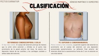 DEFORMIDAD CONDROCORPORAL O BAJA PC SUPERIOR O CONDROMANUBRIAL
El tipo más común. El cuerpo del esternón protruye de manera
que la unión entre esternón y xifoides es el punto más
prominente de la pared anterior del tórax. Se asocia con
depresión lateral de las costillas y los cartílagos costales a
ambos lados del esternón.
Menos común y más complejo. La porción superior del esternón es
prominente con el cuerpo del esternón con una depresión
pronunciada posteriormente. La deflexión final anterior del
esternón distal da la característica forma de Z con el esternón en
una vista lateral.
CLASIFICACIÓN
GÉNESIS MARTÍNEZ | X SEMESTREt
PECTUS CARINATUM
 