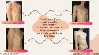 Pectus carinatum leve
Pectus carinatum asimétrico
Pectus carinatum severo
Pectus carinatum asimétrico
También se clasifican
según la simetría
(simétricos y
asimétricos), la severidad
(leves, moderados o
graves) y la amplitud de la
deformidad.
GÉNESIS MARTÍNEZ | X SEMESTREt
PECTUS CARINATUM
 