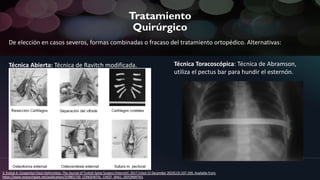 Tratamiento
Quirúrgico
De elección en casos severos, formas combinadas o fracaso del tratamiento ortopédico. Alternativas:
Técnica Abierta: Técnica de Ravitch modificada.
MM.DD.20XXADD A FOOTER12
Técnica Toracoscópica: Técnica de Abramson,
utiliza el pectus bar para hundir el esternón.
3. Kutluk A. Congenital Chest Deformities. The Journal of Turkish Spine Surgery [Internet]. 2017 [cited 15 December 2019];(3):197-199. Available from:
https://www.researchgate.net/publication/319801730_CONGENITAL_CHEST_WALL_DEFORMITIES
 