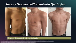 Antes y Después delTratamiento Quirúrgico
A: antes de cirugía. B y C : post cirugía13
3. Kutluk A. Congenital Chest Deformities. The Journal of Turkish Spine Surgery [Internet]. 2017 [cited 15 December 2019];(3):197-199. Available from:
https://www.researchgate.net/publication/319801730_CONGENITAL_CHEST_WALL_DEFORMITIES
 