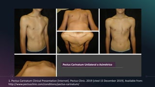 7
Pectus Carinatum Unilateral o Asimétrico
1. Pectus Carinatum Clinical Presentation [Internet]. Pectus Clinic. 2019 [cited 15 December 2019]. Available from:
http://www.pectusclinic.com/conditions/pectus-carinatum/
 