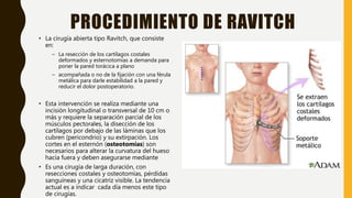 Ravitch Incision Pectus excavatum | PPTX