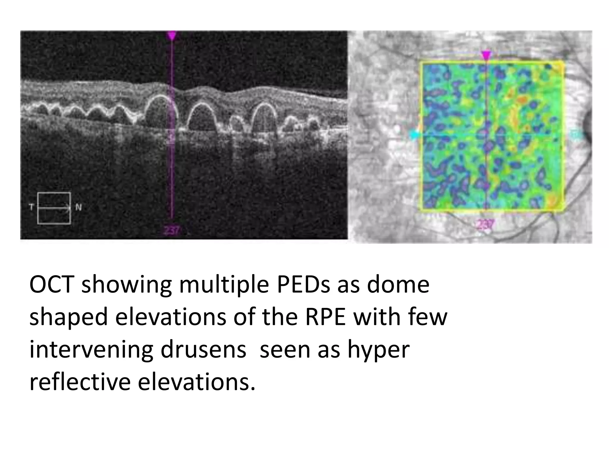Pigment epithelial detachment (PED) | PPTX