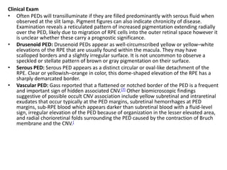 Clinical Exam
• Often PEDs will transilluminate if they are filled predominantly with serous fluid when
observed at the slit lamp. Pigment figures can also indicate chronicity of disease.
Examination reveals a reticulated pattern of increased pigmentation extending radially
over the PED, likely due to migration of RPE cells into the outer retinal space however it
is unclear whether these carry a prognostic significance.
• Drusenoid PED: Drusenoid PEDs appear as well-circumscribed yellow or yellow–white
elevations of the RPE that are usually found within the macula. They may have
scalloped borders and a slightly irregular surface. It is not uncommon to observe a
speckled or stellate pattern of brown or gray pigmentation on their surface.
• Serous PED: Serous PED appears as a distinct circular or oval-like detachment of the
RPE. Clear or yellowish–orange in color, this dome-shaped elevation of the RPE has a
sharply demarcated border.
• Vascular PED: Gass reported that a flattened or notched border of the PED is a frequent
and important sign of hidden associated CNV.[7] Other biomicroscopic findings
suggestive of possible occult CNV association include yellow subretinal and intraretinal
exudates that occur typically at the PED margins, subretinal hemorrhages at PED
margins, sub-RPE blood which appears darker than subretinal blood with a fluid-level
sign, irregular elevation of the PED because of organization in the lesser elevated area,
and radial chorioretinal folds surrounding the PED caused by the contraction of Bruch
membrane and the CNV.[
 