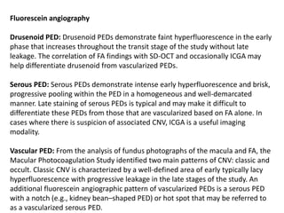 Fluorescein angiography
Drusenoid PED: Drusenoid PEDs demonstrate faint hyperfluorescence in the early
phase that increases throughout the transit stage of the study without late
leakage. The correlation of FA findings with SD-OCT and occasionally ICGA may
help differentiate drusenoid from vascularized PEDs.
Serous PED: Serous PEDs demonstrate intense early hyperfluorescence and brisk,
progressive pooling within the PED in a homogeneous and well-demarcated
manner. Late staining of serous PEDs is typical and may make it difficult to
differentiate these PEDs from those that are vascularized based on FA alone. In
cases where there is suspicion of associated CNV, ICGA is a useful imaging
modality.
Vascular PED: From the analysis of fundus photographs of the macula and FA, the
Macular Photocoagulation Study identified two main patterns of CNV: classic and
occult. Classic CNV is characterized by a well-defined area of early typically lacy
hyperfluorescence with progressive leakage in the late stages of the study. An
additional fluorescein angiographic pattern of vascularized PEDs is a serous PED
with a notch (e.g., kidney bean–shaped PED) or hot spot that may be referred to
as a vascularized serous PED.
 