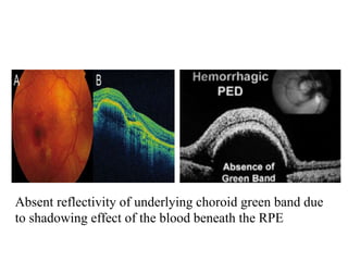 Absent reflectivity of underlying choroid green band due
to shadowing effect of the blood beneath the RPE
 