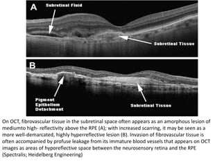 On OCT, fibrovascular tissue in the subretinal space often appears as an amorphous lesion of
mediumto high- reflectivity above the RPE (A); with increased scarring, it may be seen as a
more well-demarcated, highly hyperreflective lesion (B). Invasion of fibrovascular tissue is
often accompanied by profuse leakage from its immature blood vessels that appears on OCT
images as areas of hyporeflective space between the neurosensory retina and the RPE
(Spectralis; Heidelberg Engineering)
 