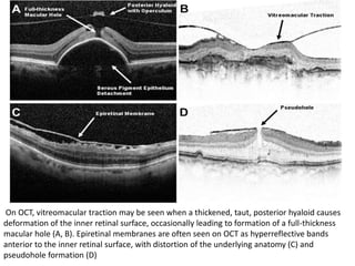 On OCT, vitreomacular traction may be seen when a thickened, taut, posterior hyaloid causes
deformation of the inner retinal surface, occasionally leading to formation of a full-thickness
macular hole (A, B). Epiretinal membranes are often seen on OCT as hyperreflective bands
anterior to the inner retinal surface, with distortion of the underlying anatomy (C) and
pseudohole formation (D)
 