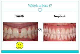 Which is best ??
Tooth
Or
Implant
 